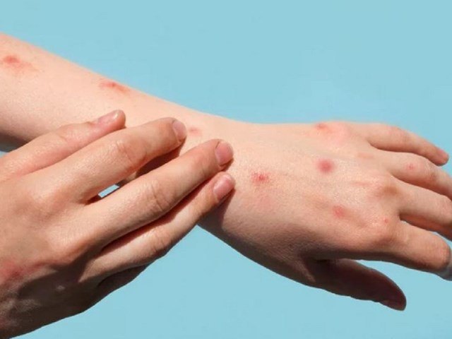 バクザン、サル痘の予防と抑制を強化 – 詳細ニュース